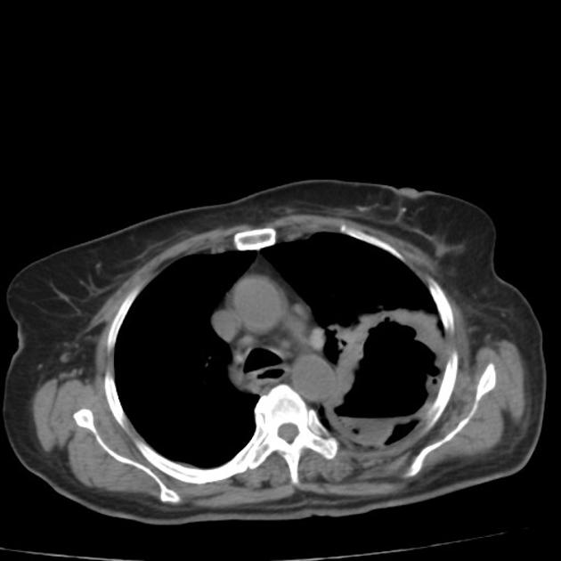pulmonary_abscess